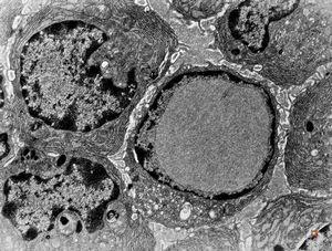 nuclear pseudoinclusion in plasmocyte nuclear pseudoinclusion in plasmocyte